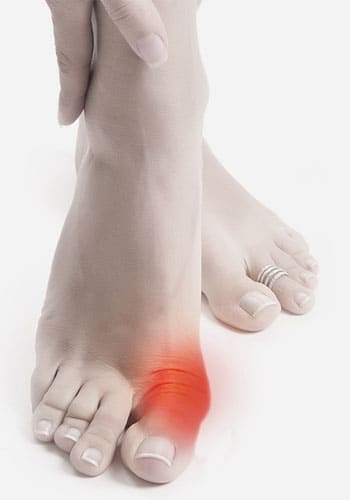 косточка на ноге