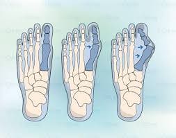 выступающая косточка на ноге