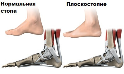 плоскостопие
