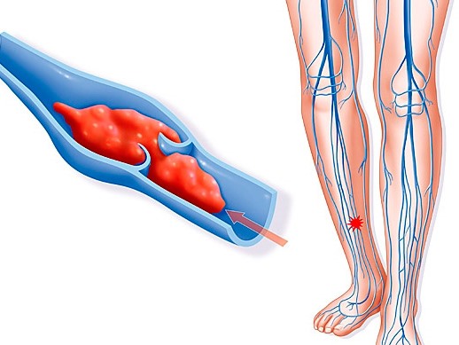 profilaktika-tromboflebita